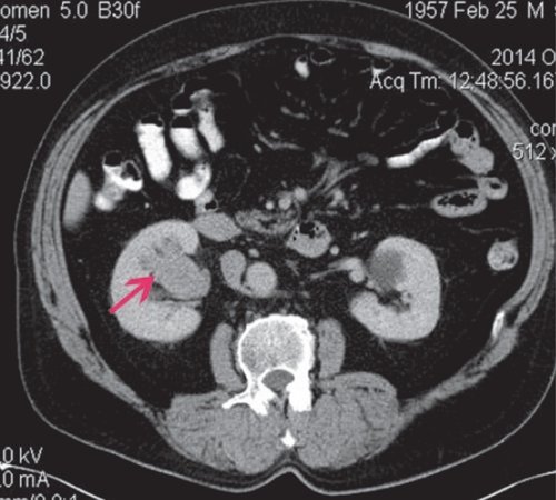 КТ почки (артериальная фаза) - образование неравномерно накапливает контрастное вещество
