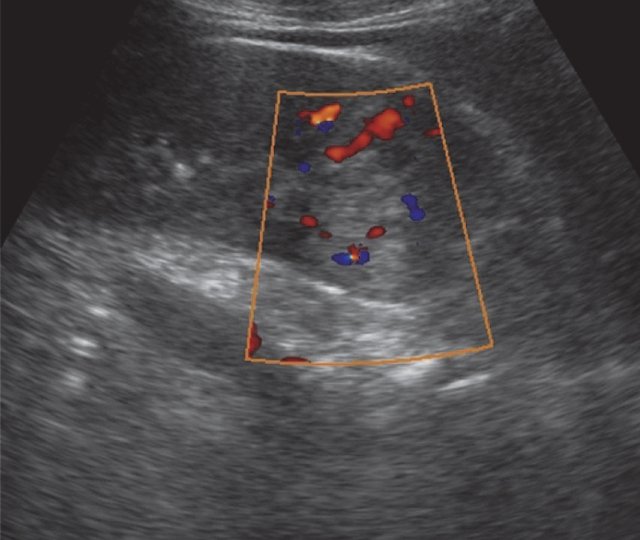УЗИ почки (режим ЦДК) - визуализируются единичные эхосигналы внутри образования