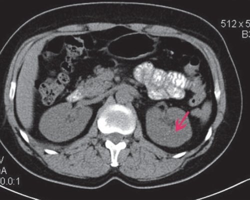 КТ почки (нативная фаза) - в паренхиме верхней трети левой почки определяется образование округлой формы, гиподенсной нативной плотности