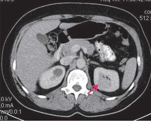 КТ почки (артериальная фаза) - диффузно накапливает контрастное вещество