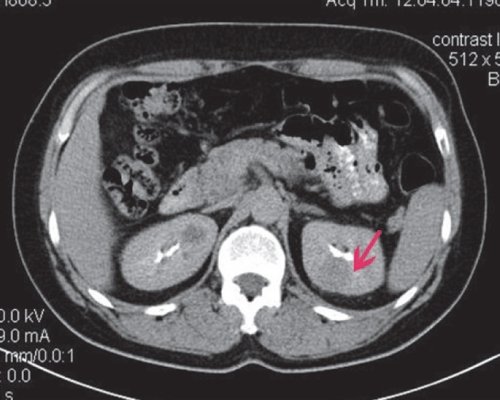 КТ почки (отсроченная фаза) - плотность образования 47 HU
