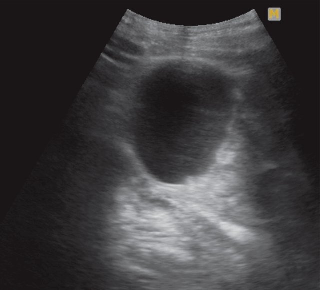 УЗИ левой почки - жидкостной компонент в объемном образовании слева