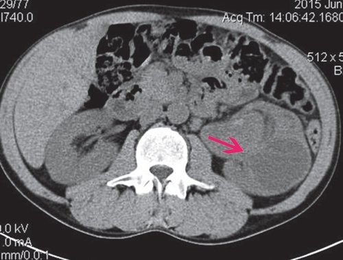 КТ левой почки (нативная фаза) - объемное образование неоднородной структуры, с тканевым и жидкостным компонентами