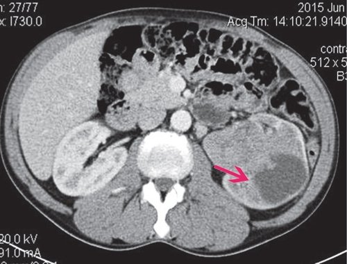 КТ левой почки (артериальная фаза) - образование неравномерно копит контрастное вещество