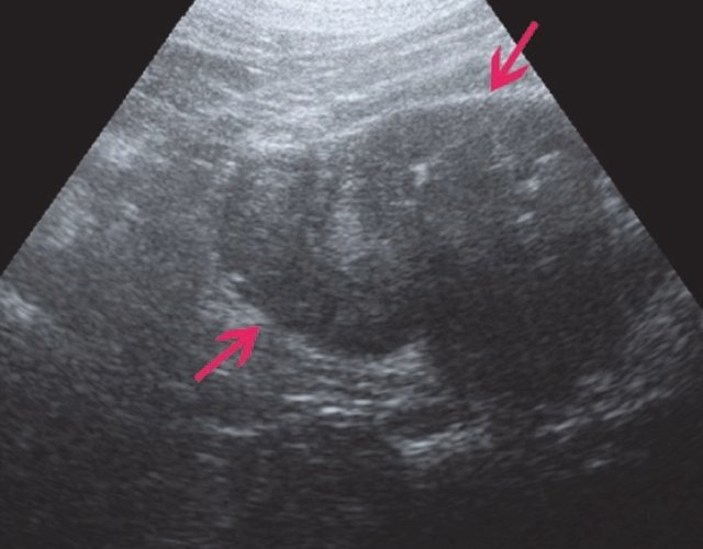 УЗИ правой почки и мочевого пузыря - в правой почке в проекции нижнего полюса визуализируется объемное образование, содержащее в своей структуре тканевые и жидкостные компоненты