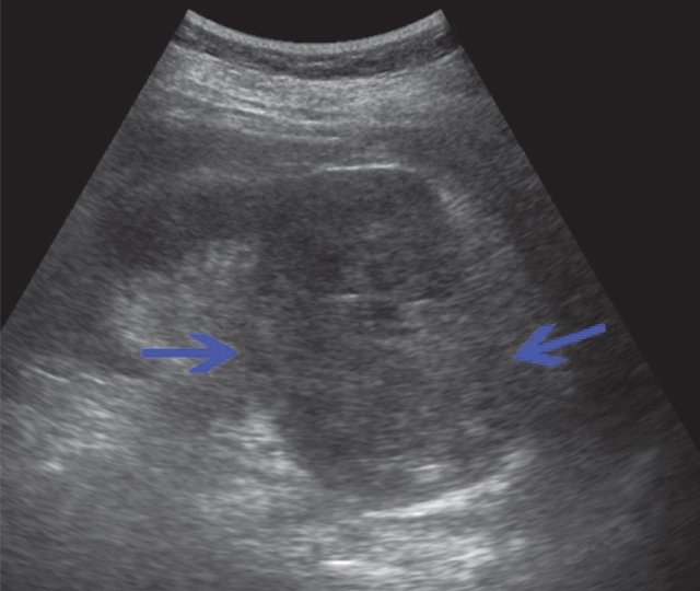 УЗИ рака почки - в проекции верхнего полюса, деформируя контур почки, визуализируется тканевое образование
