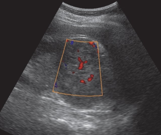 УЗИ рака почки (режим ЦДК) - визуализируются отдельные сосудистые сигналы внутри образования