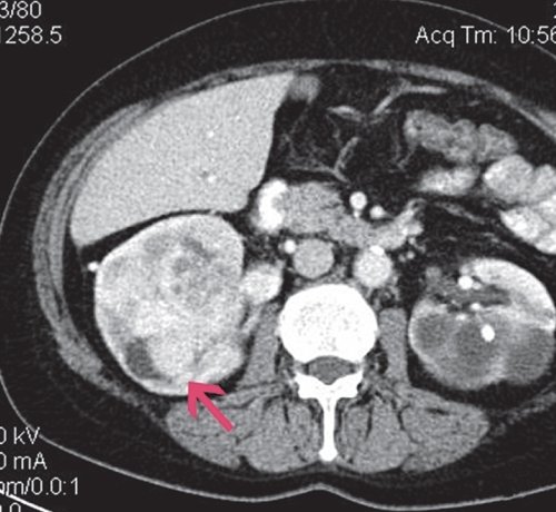 КТ рака почки (артериальная фаза) - образование фрагментарно накапливает контрастное вещество