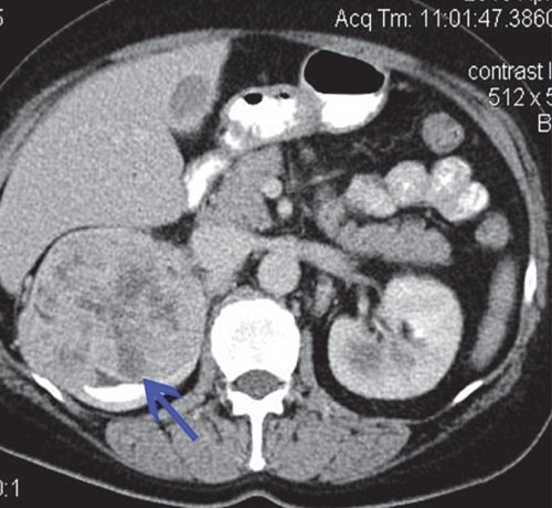 КТ рака почки (отстроченная фаза) - фрагментарные признаки дефекта наполнения