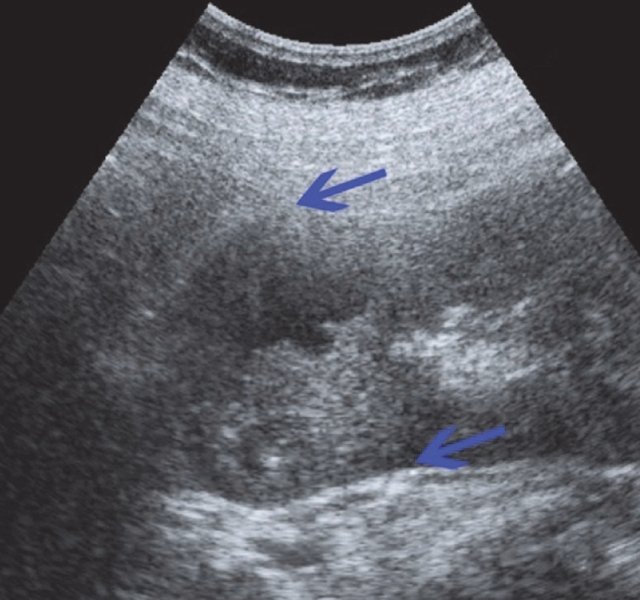 УЗИ единственной правой почки - в проекции нижнего полюса визуализируется образование жидкостного характера, выходящее на контур почки, содержащее в своей структуре пристеночный тканевой компонент и перегородки