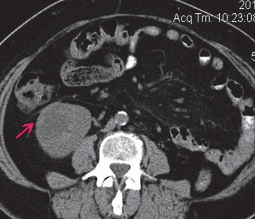 КТ единственной правой почки (нативная фаза) - в нижней трети паренхимы, с выходом на контур, округлое образование, частично выходящее на латеральный контур, кистозно-солидной структуры
