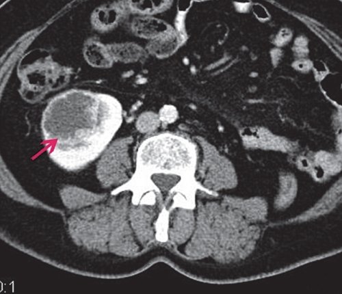 КТ единственной правой почки (артериальная фаза) - образование, достаточно интенсивно накапливающее контрастное вещество по периферии