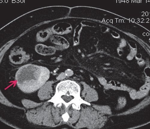 КТ единственной правой почки (отсроченная фаза) - фрагментарные признаки дефекта наполнения