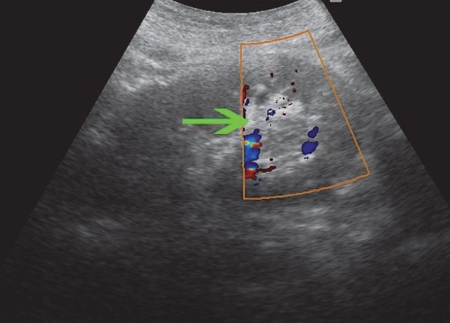 УЗИ правой почки (режим ЦДК) - визуализируются отдельные сосудистые сигналы внутри образования