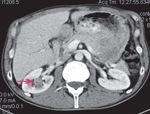 КТ правой почки (артериальная фаза) - образование неравномерно накапливает контрастное вещество