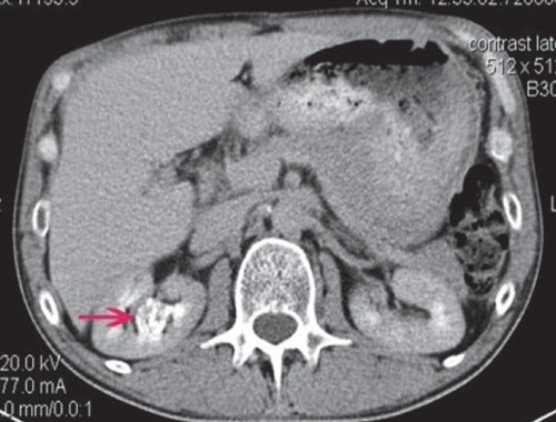 КТ правой почки (отсроченная фаза) - фрагментарные признаки дефекта наполнения чашечек