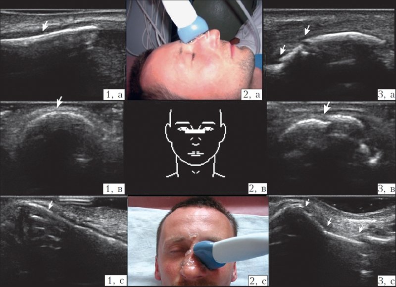 Ультразвуковое исследование носа (норма и переломы). 1 - кости носа без признаков перелома (на кости носа указывает стрелка). 2 - расположение датчика при исследовании (2а, 2с - на фото, 2в - схематично). 3 - переломы костей носа (места перелома обозначены стрелкой). а - датчик расположен продольно на спинке носа. в - датчик расположен поперечно на спинке носа. с - датчик расположен поперечно на левом скате носа