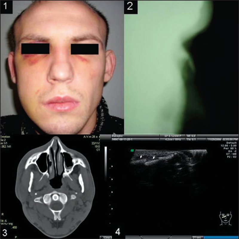 Перелом костей носа в области правого бокового ската носа: 1 - фотография, 2 - боковая рентгенограмма, 3 - компьютерная томограмма, 4 - эхограмма