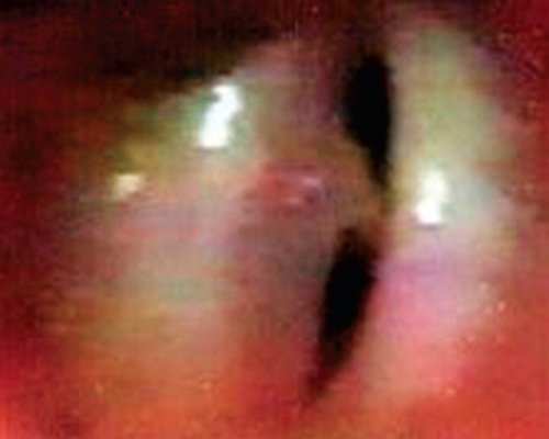 Эндоскопия гортани - папиллома правой голосовой складки