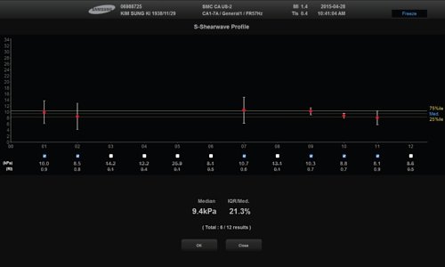 Технология S-Shearwave - шкала жесткости ткани