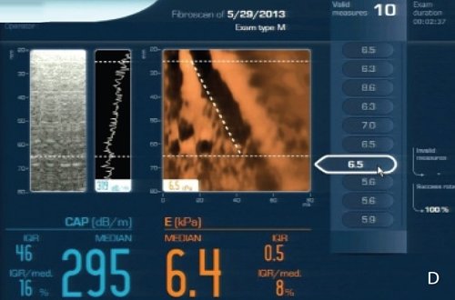 Транзиентная эластография - значение жесткости ткани печени 6,4 кПа