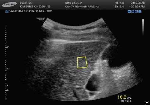 Эхограмма печени - измерение жесткости ткани в V сегменте (10,0 кПа при RMI=0,9)