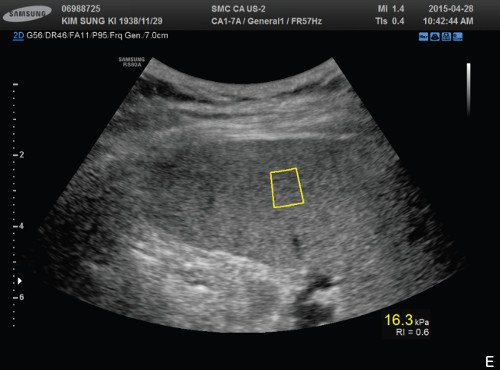 Эхограмма селезенки - измерение жесткости ткани (6,3 кПа при RMI=0,6)