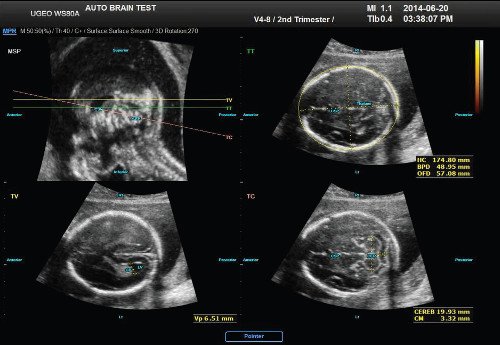 На эхограмме: 5D УЗИ ЦНС плода (биометрия головного мозга)