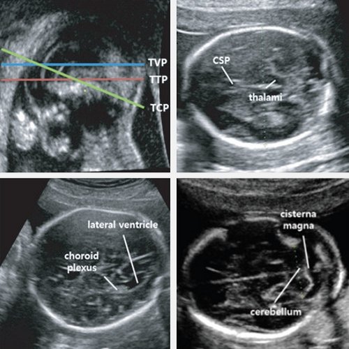 УЗИ головного мозга плода (thalami - зрительные бугры, choroid plexus - сосудистое сплетение, lateral ventricle - боковой желудочек, cisterna magna - большая цистерна, cerebellum - мозжечок