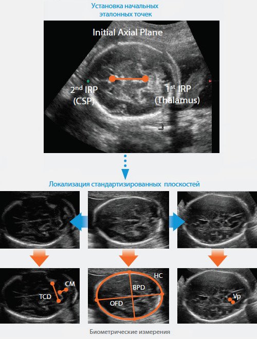 Схема алгоритма УЗИ головного мозга плода
