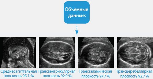 Эхограммы и процент эффективности биометрии головного мозга плода для среднесагиттальной и трех аксиальных плоскостей