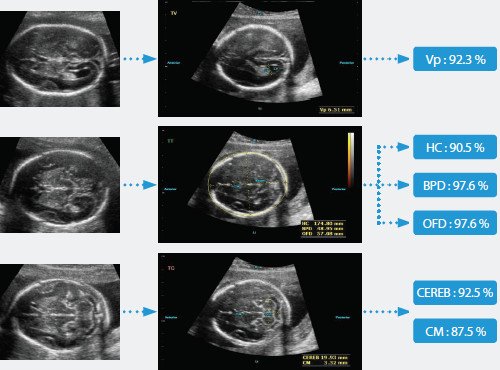 Эхограммы и процент эффективности для шести биометрических измерений головного мозга плода