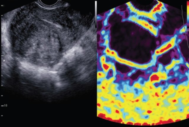 Слева - эхограмма в оттенках серого, справа - эластография с картой нарастания цветов