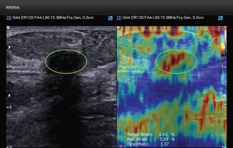 Эластография - фиброаденома