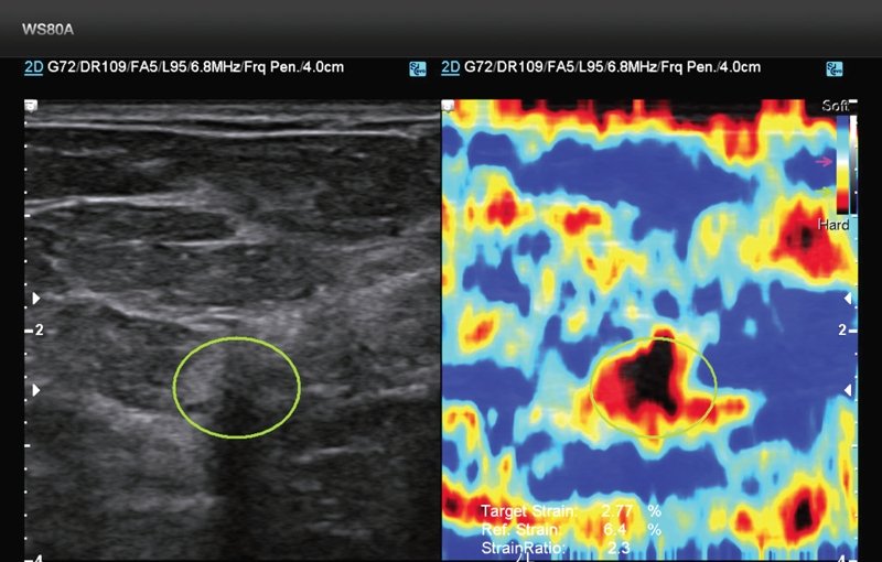 Эластография - небольшой узел инвазивного рака молочной железы (G1), эхо-плотные границы которого попадают в изучаемую область