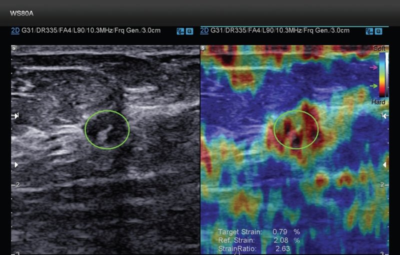 Эластография - инвазивный рак молочной железы (G2), при котором гипоэхогенная область поражения полностью размещалась в изучаемой области