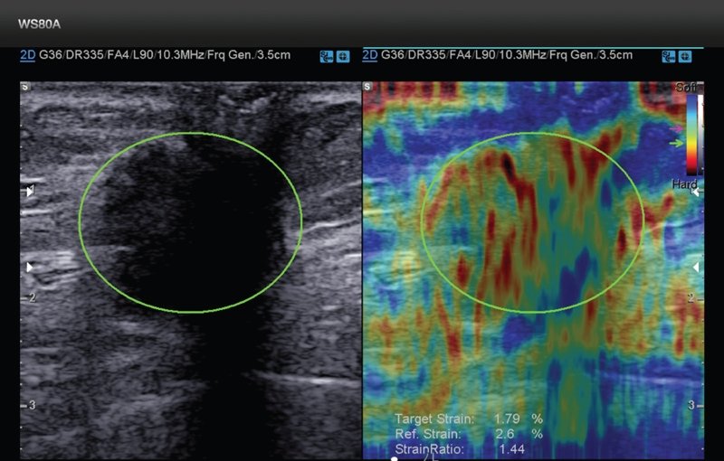 Эластография - более крупный локальный рецидив рака молочной железы