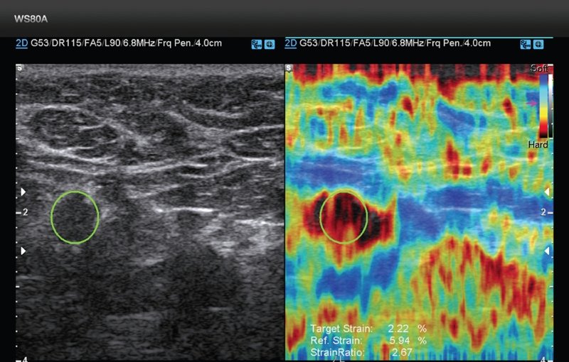 Эластография - метастаз в подмышечный лимфоузел у пациентки с раком молочной железы
