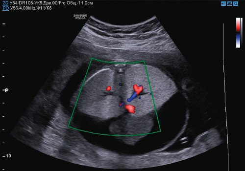 УЗИ плода - поперечный скан, расширенное бронхиальное дерево