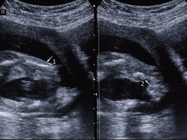 Эхограмма - укороченные искривленные большеберцовые кости плода (б)