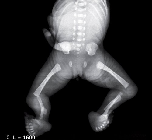 Цифровая рентгенограмма абортуса с синдромом Werner`а
