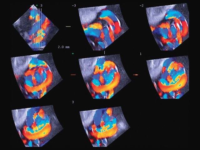 Эхограмма - истинный узел пуповины в режиме 3D + ЦДК и STIC