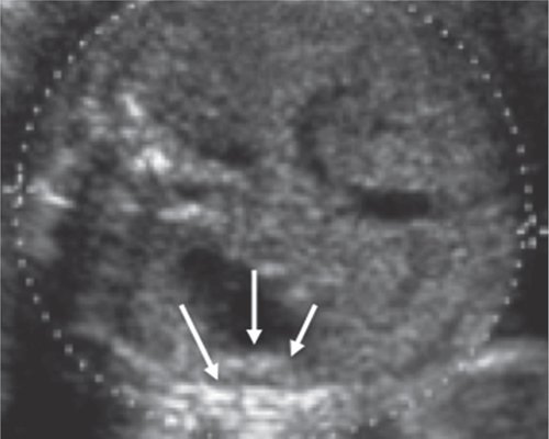 Эхограмма - аксиальное сечение туловища плода на уровне портального синуса, селезенка плода обозначена стрелками