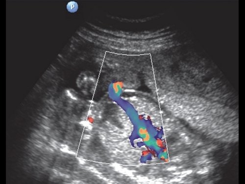 Эхограмма - гемолитическая болезнь плода - дилатация вены пуповины в интраабдоминальном отделе