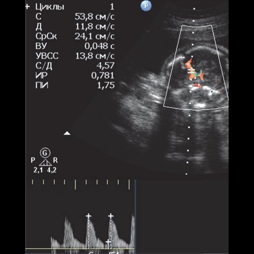 Эхограмма - гемолитическая болезнь плода - ПСС СМА 53,8 см/с
