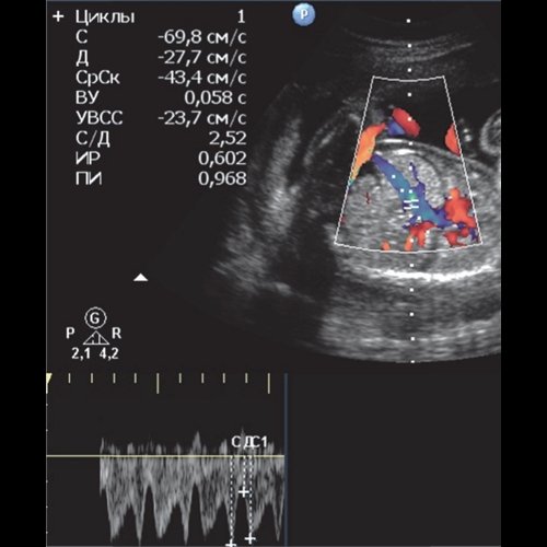 Эхограмма - гемолитическая болезнь плода - кровоток в венозном протоке плода