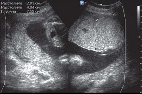Эхограмма - гемолитическая болезнь плода у дихориальных близнецов - дискордантность толщины плацент близнецов, плацентомегалия первого плода