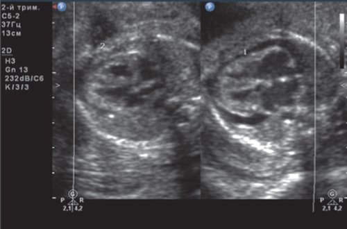 Эхограмма - гемолитическая болезнь плода у дихориальных близнецов - дискордантность размеров сердец плодов, дилатационная кардиомегалия первого плода