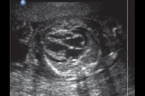 Эхограмма - гемолитическая болезнь плода у дихориальных близнецов - прогрессирующая дилатация камер сердца и гидроперикард первого плода