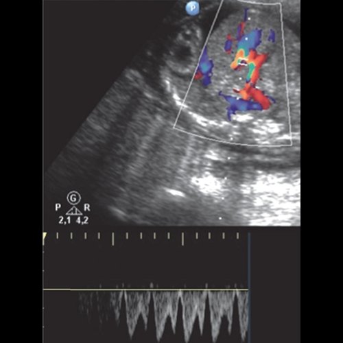 Эхограмма - гемолитическая болезнь плода у дихориальных близнецов - кровоток ВП с нормальными индексами резистентности и сниженной фазой ИВР и реверсный кровоток ВП через 4 дня